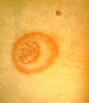 Kruhová skvrna na kůži