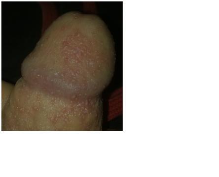 Nedávno kvasinky, teď napuchlá předkožka