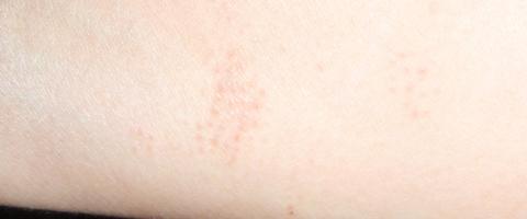 Pupinky jeden vedle druheho na predlokti